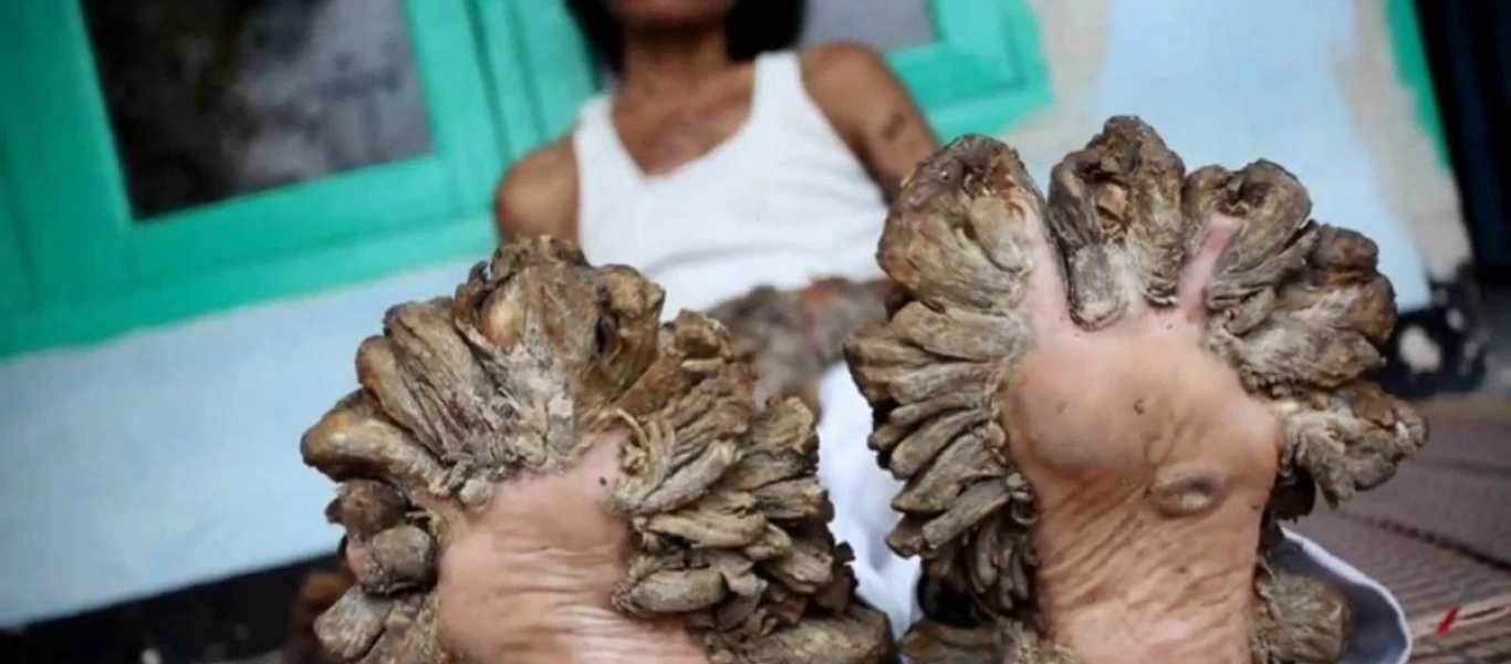 Παράξενες ασθένειες που κανείς δεν πιστεύει ότι υπάρχουν αλλά είναι αληθινές!